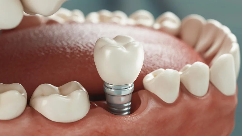 Dental implant to replace a missing tooth at B&R Dentists in Darien, IL