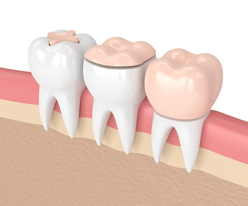 Dental inlay restoration at B&R Dentists in Darien, IL